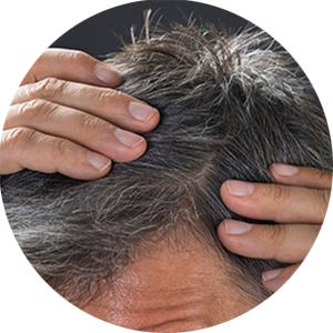 PROFILE_hair_transplant_300x300